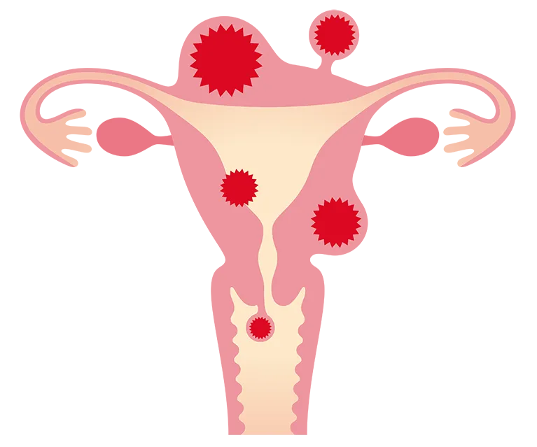 子宮筋腫とは