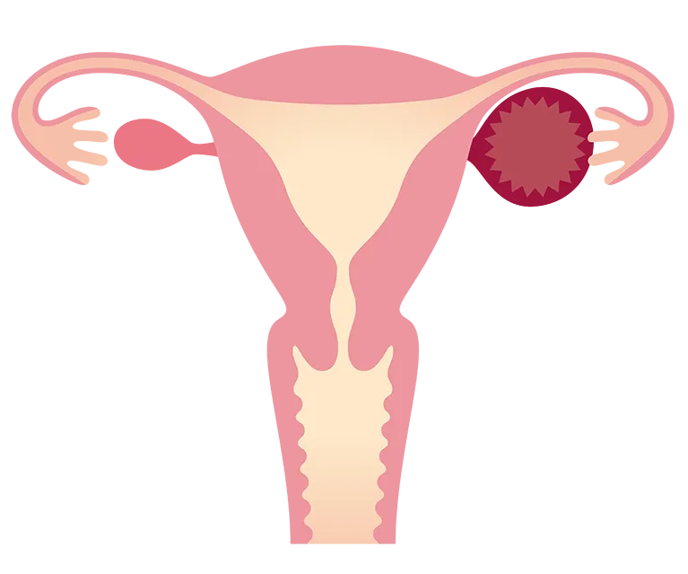 卵巣嚢腫とは